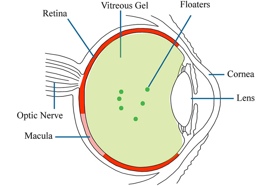 retinal detachment floaters