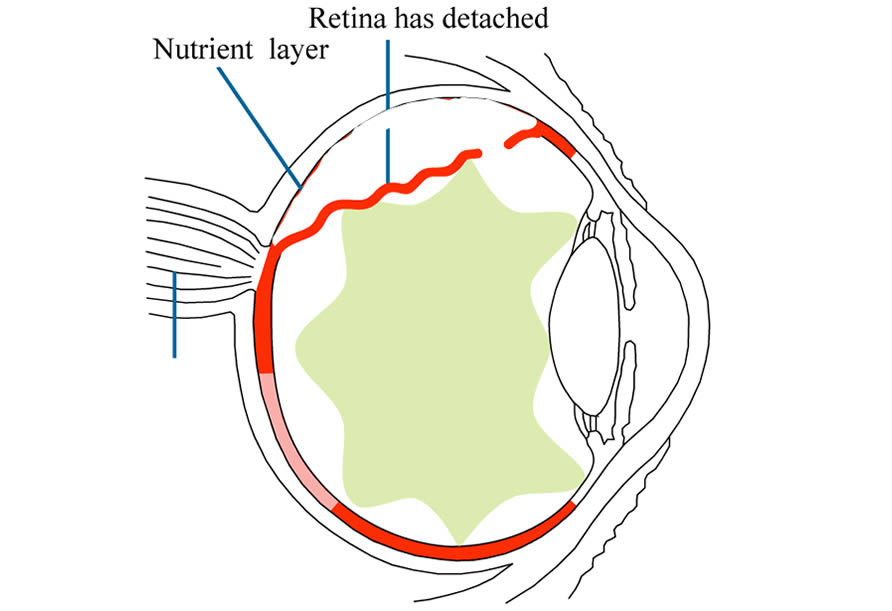 partially torn retina